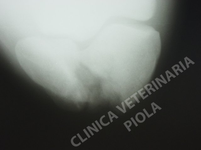 Frattura saggittale della rotula